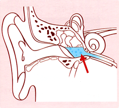 滲出性性（しんしゅつせい）中耳炎の図