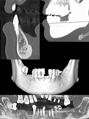 インプラントCT画像