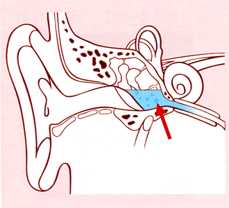 滲出性性（しんしゅつせい）中耳炎